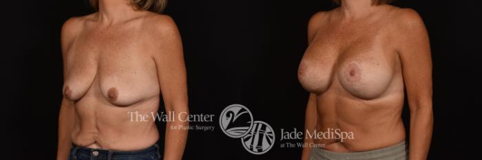 Before & After Breast Augmentation with Lift Case 1034 Left Oblique View in Shreveport, LA