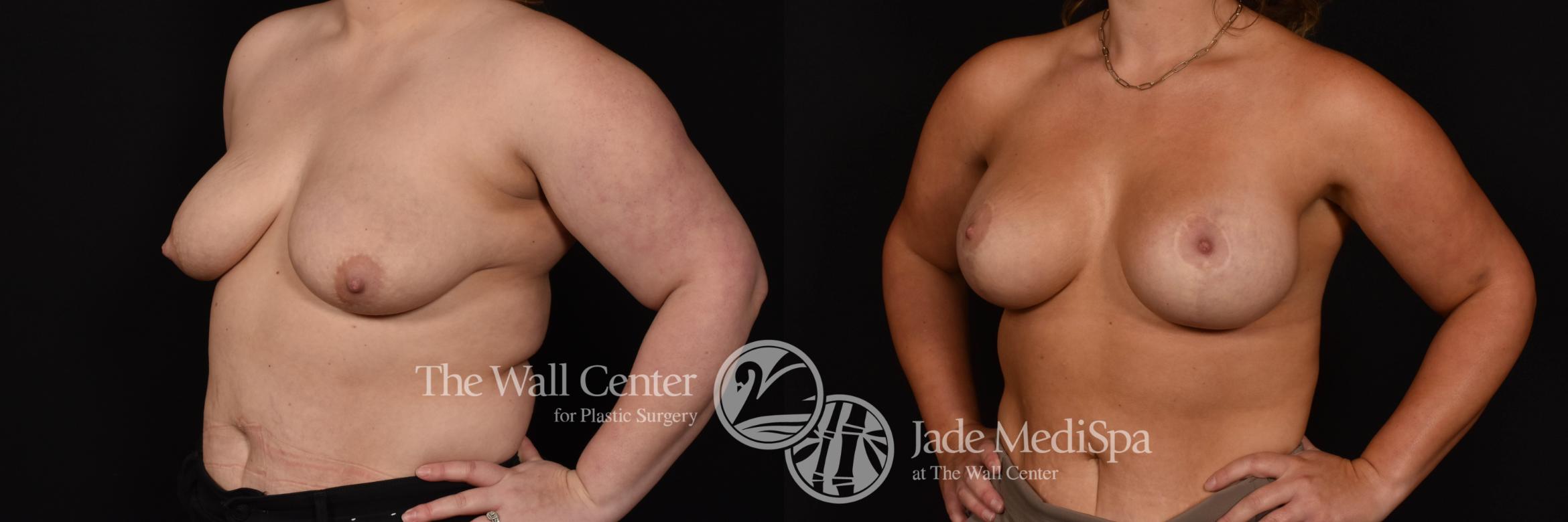 Before & After Breast Augmentation with Lift Case 1045 Left Oblique View in Shreveport, LA