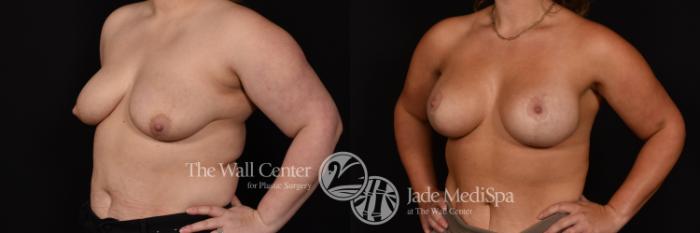 Before & After Breast Augmentation with Lift Case 1045 Left Oblique View in Shreveport, LA
