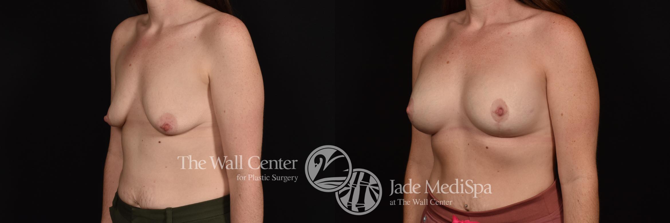 Before & After Breast Augmentation with Lift Case 1052 Left Oblique View in Shreveport, LA