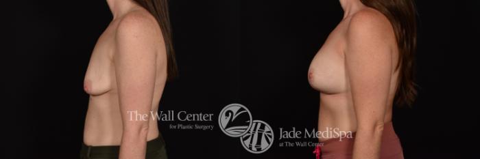 Before & After Breast Augmentation with Lift Case 1052 Left Side View in Shreveport, LA