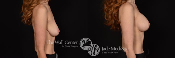 Before & After Breast Augmentation with Lift Case 1058 Right Side View in Shreveport, LA
