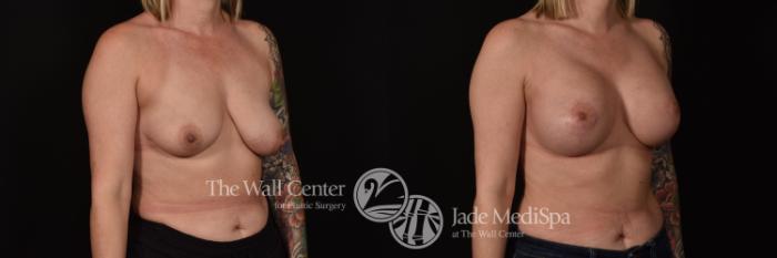 Before & After Breast Augmentation with Lift Case 1070 Right Oblique View in Shreveport, LA
