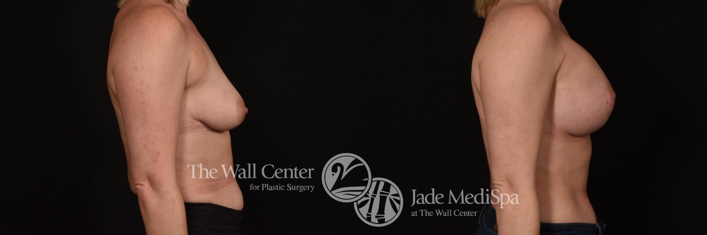Before & After Breast Augmentation with Lift Case 1070 Right Side View in Shreveport, LA