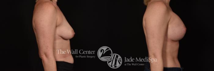 Before & After Breast Augmentation with Lift Case 1070 Right Side View in Shreveport, LA