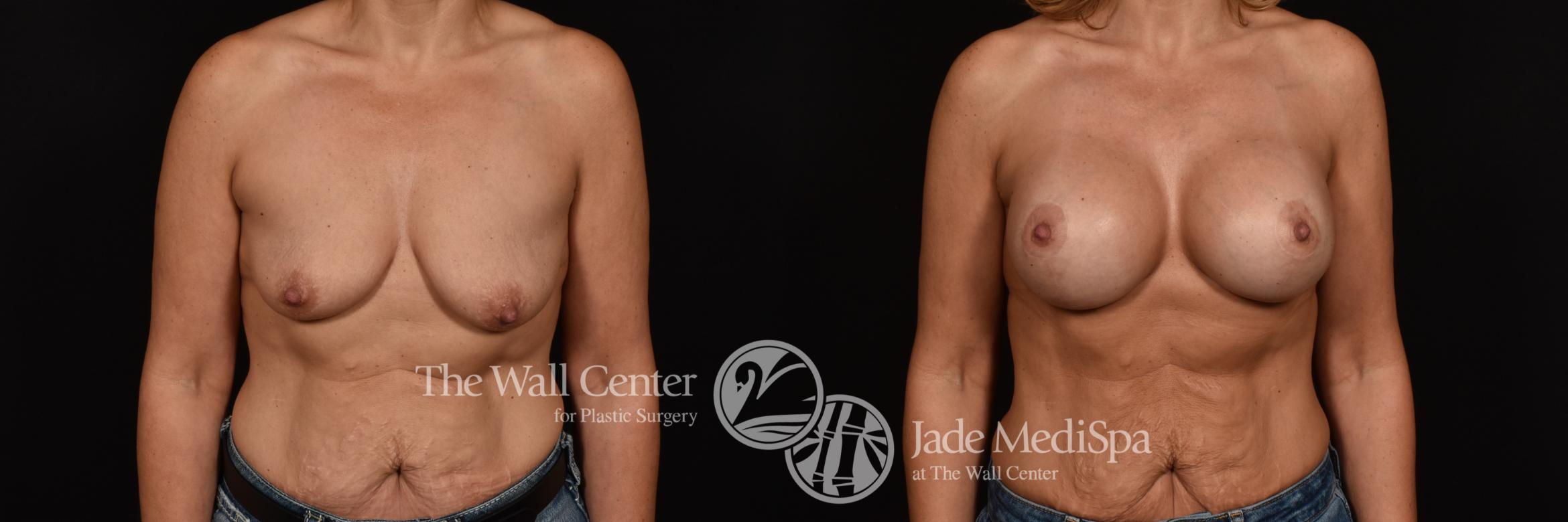 Before & After Breast Augmentation with Lift Case 1071 Front View in Shreveport, LA