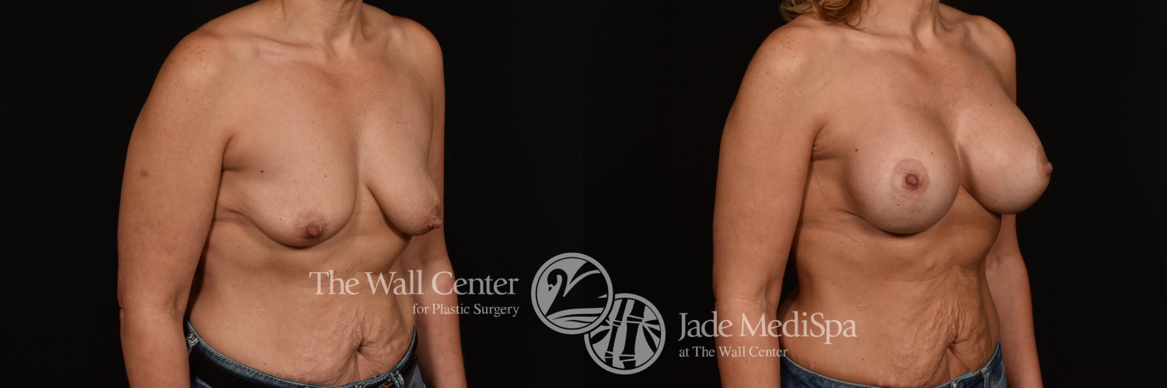 Before & After Breast Augmentation with Lift Case 1071 Right Oblique View in Shreveport, LA