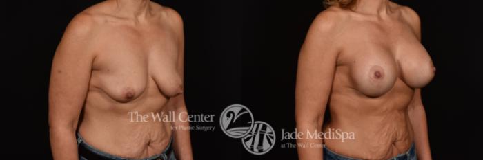 Before & After Breast Augmentation with Lift Case 1071 Right Oblique View in Shreveport, LA