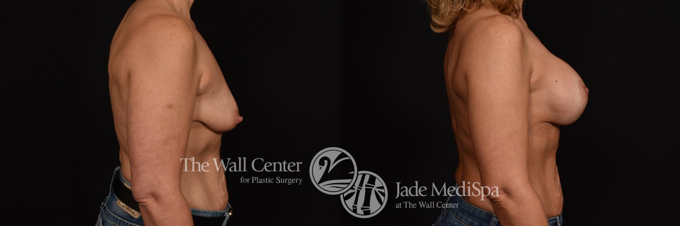 Before & After Breast Augmentation with Lift Case 1071 Right Side View in Shreveport, LA