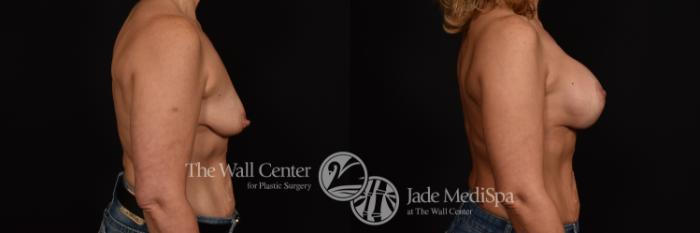 Before & After Breast Augmentation with Lift Case 1071 Right Side View in Shreveport, LA