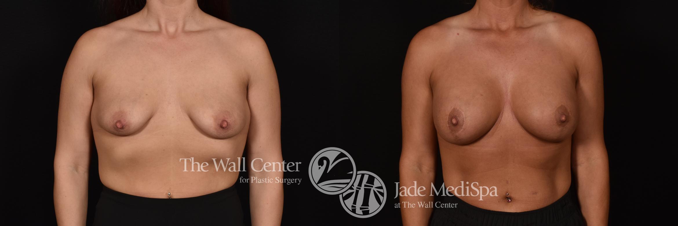 Before & After Breast Augmentation with Lift Case 1085 Front View in Shreveport, LA