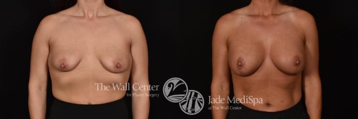 Before & After Breast Augmentation with Lift Case 1085 Front View in Shreveport, LA