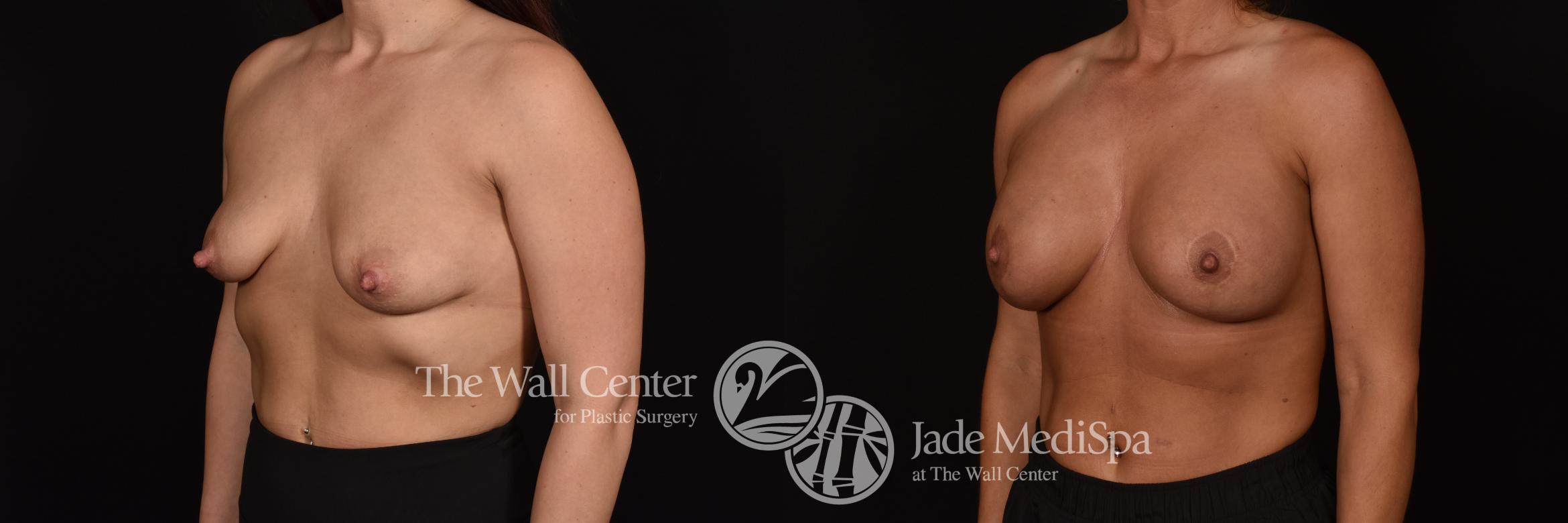 Before & After Breast Augmentation with Lift Case 1085 Left Oblique View in Shreveport, LA
