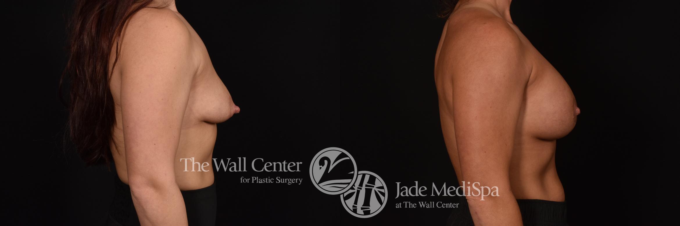 Before & After Breast Augmentation with Lift Case 1085 Right Side View in Shreveport, LA