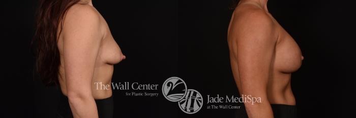 Before & After Breast Augmentation with Lift Case 1085 Right Side View in Shreveport, LA