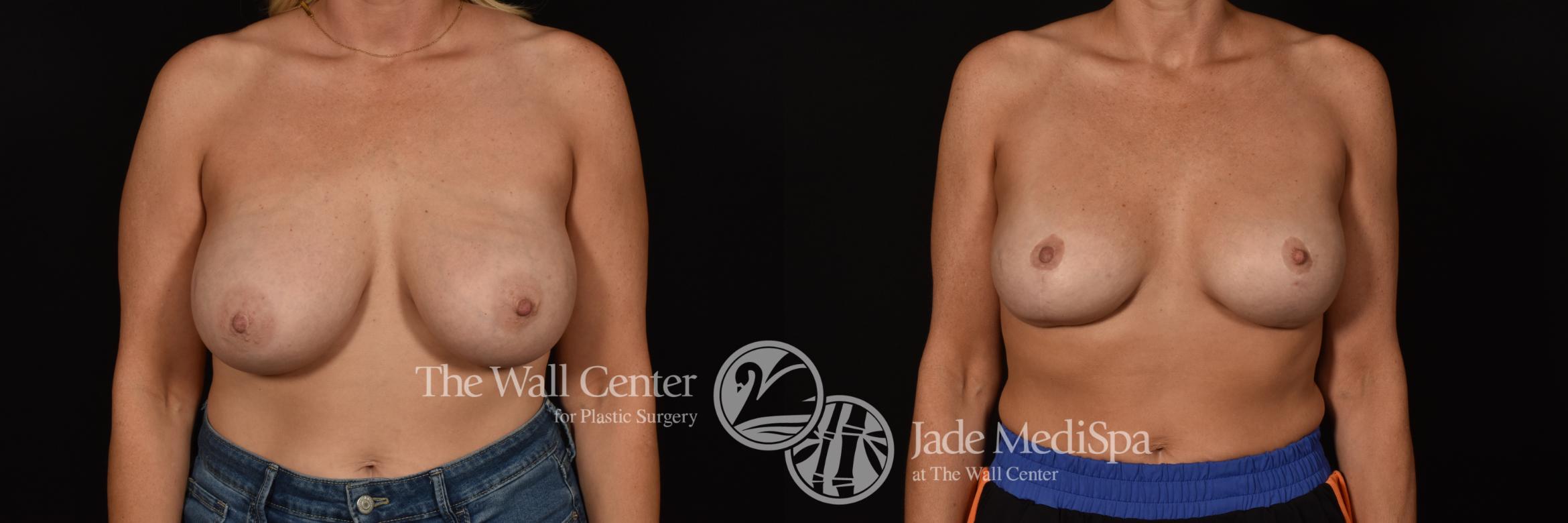 Before & After Breast Augmentation with Lift Case 1086 Front View in Shreveport, LA