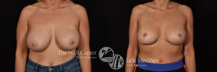 Before & After Breast Augmentation with Lift Case 1086 Front View in Shreveport, LA