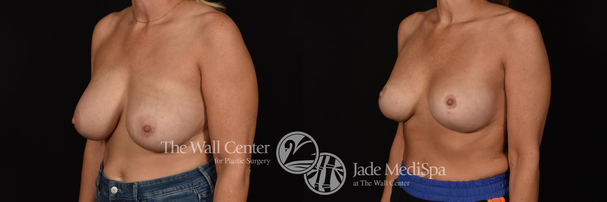 Before & After Breast Augmentation with Lift Case 1086 Left Oblique View in Shreveport, LA