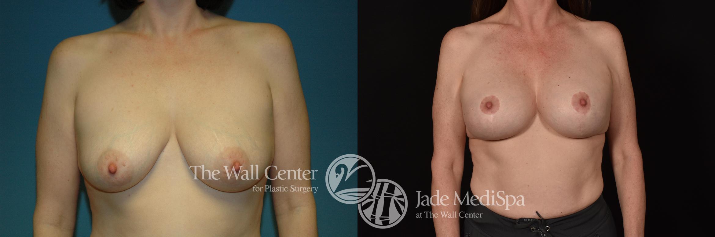 Before & After Breast Augmentation with Lift Case 1094 Front View in Shreveport, LA