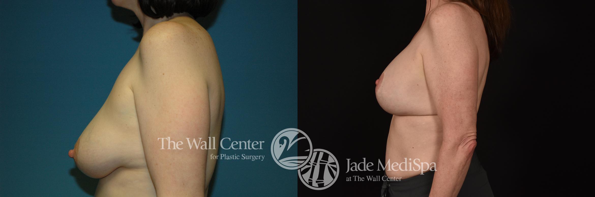 Before & After Breast Augmentation with Lift Case 1094 Left Side View in Shreveport, LA