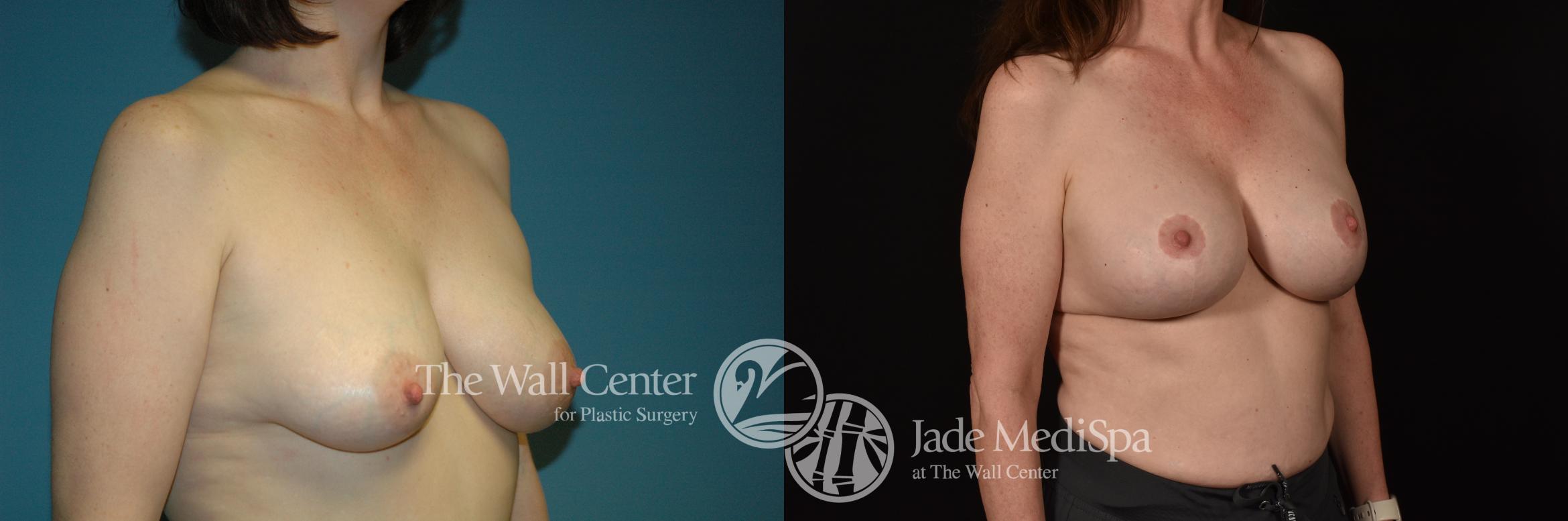 Before & After Breast Augmentation with Lift Case 1094 Right Oblique View in Shreveport, LA