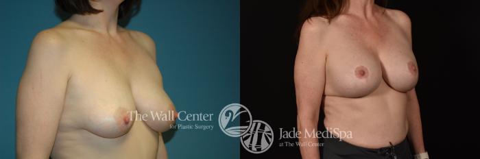 Before & After Breast Augmentation with Lift Case 1094 Right Oblique View in Shreveport, LA
