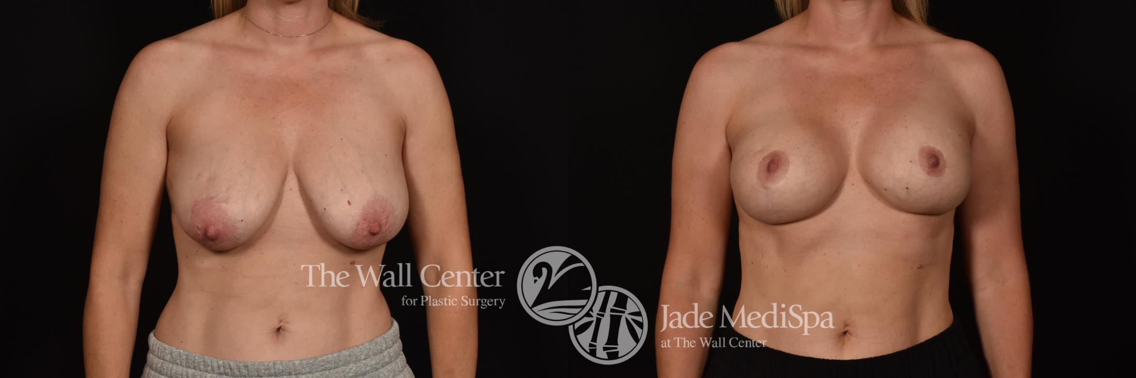 Before & After Breast Augmentation with Lift Case 1098 Front View in Shreveport, LA