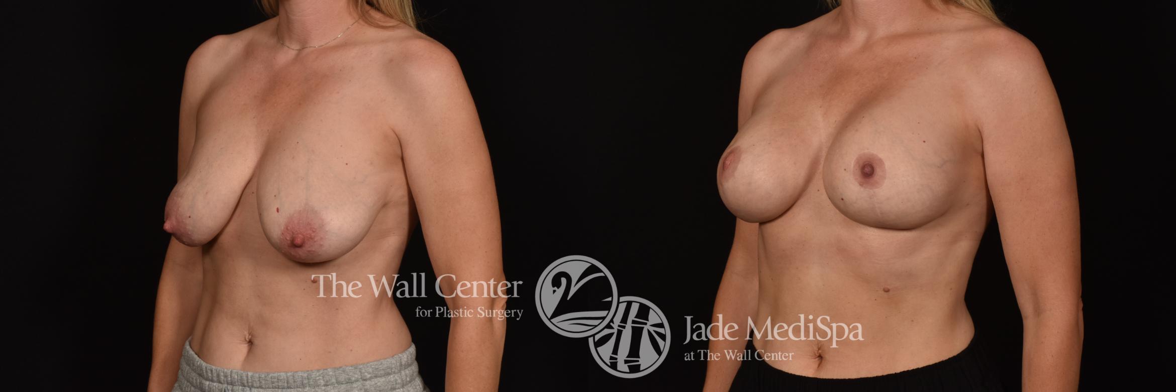 Before & After Breast Augmentation with Lift Case 1098 Left Oblique View in Shreveport, LA