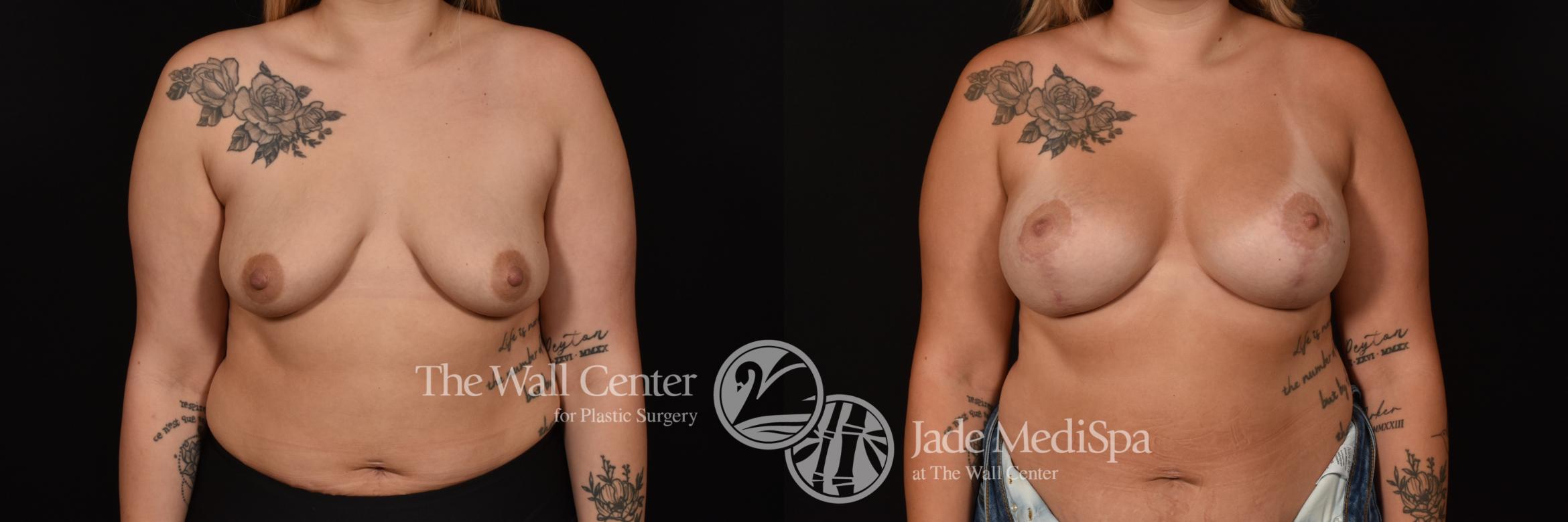 Before & After Breast Augmentation with Lift Case 1099 Front View in Shreveport, LA