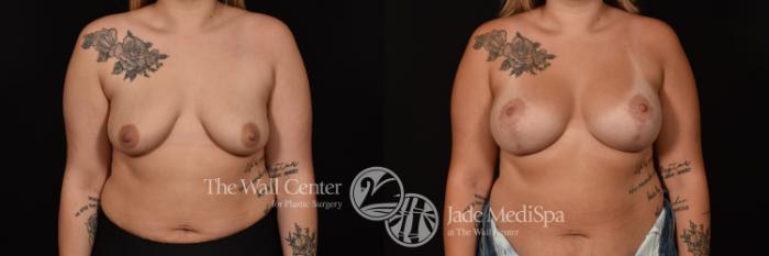 Before & After Breast Augmentation with Lift Case 1099 Front View in Shreveport, LA