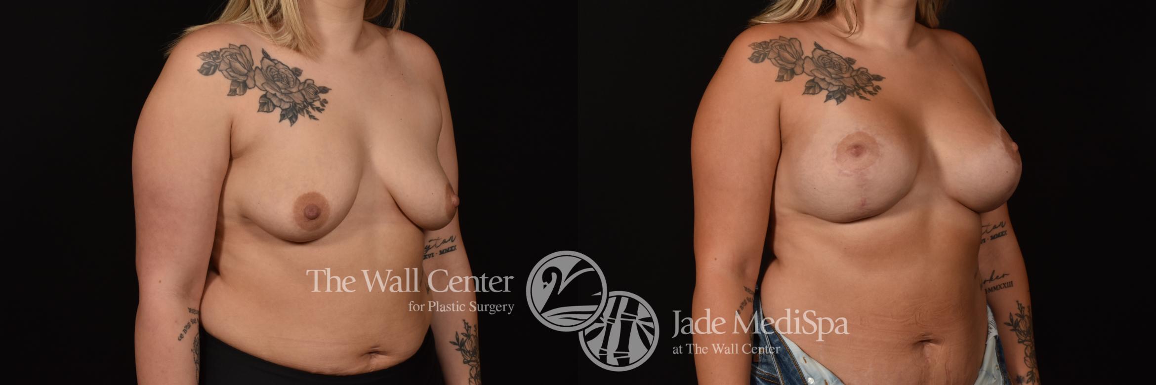 Before & After Breast Augmentation with Lift Case 1099 Right Oblique View in Shreveport, LA