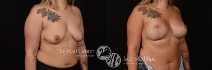 Before & After Breast Augmentation with Lift Case 1099 Right Oblique View in Shreveport, LA