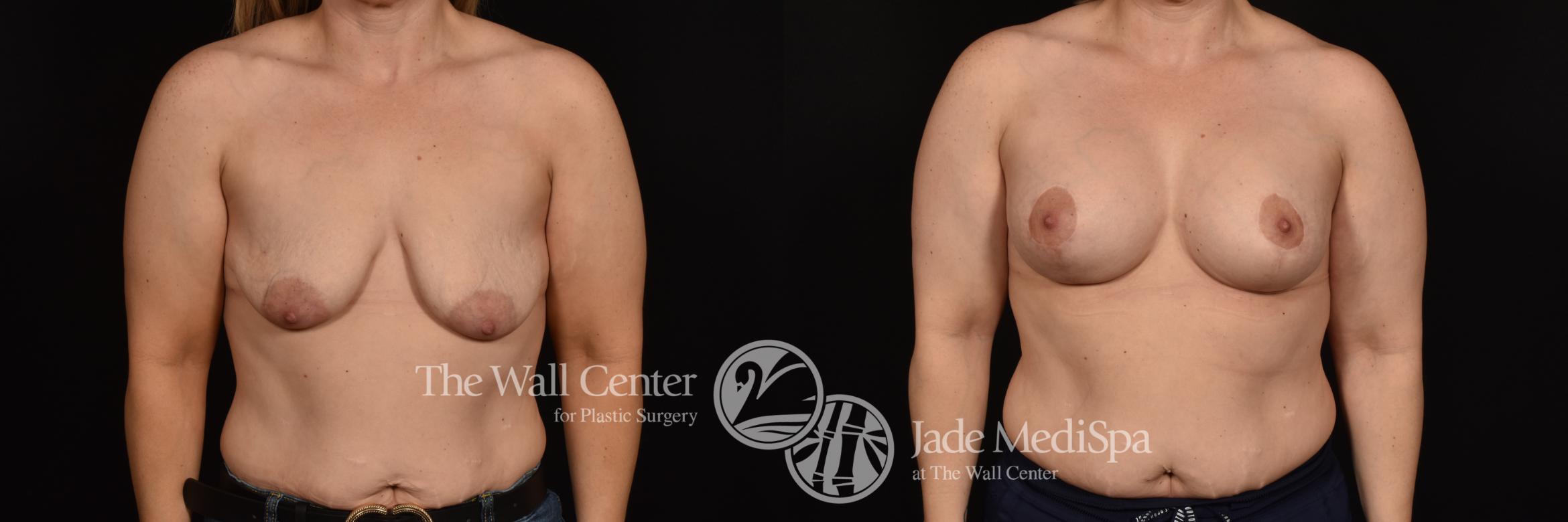 Before & After Breast Augmentation with Lift Case 1114 Front View in Shreveport, LA