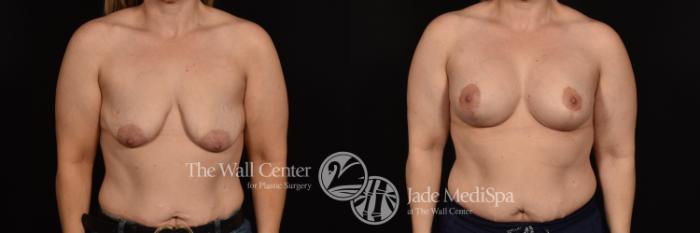 Before & After Breast Augmentation with Lift Case 1114 Front View in Shreveport, LA