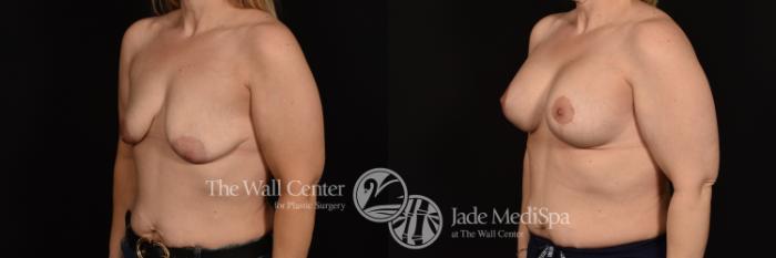 Before & After Breast Augmentation with Lift Case 1114 Left Oblique View in Shreveport, LA