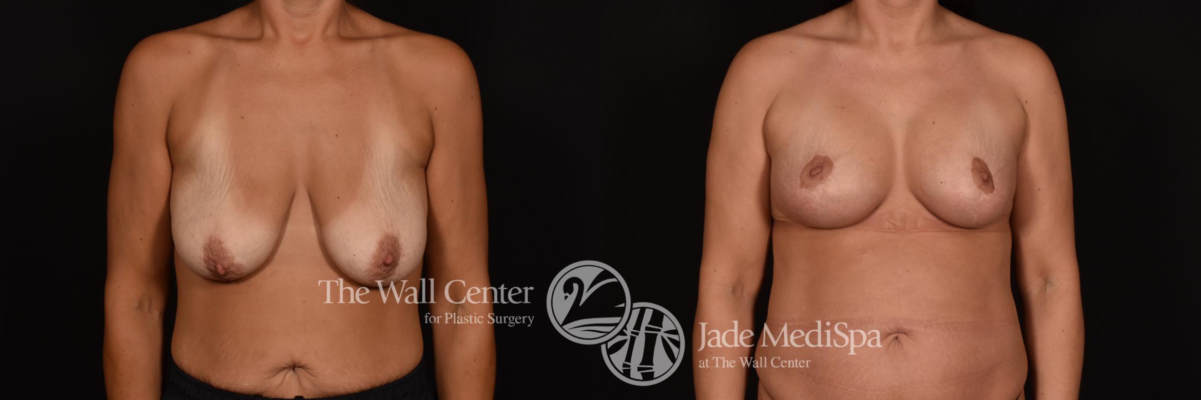Before & After Breast Augmentation with Lift Case 1115 Front View in Shreveport, LA