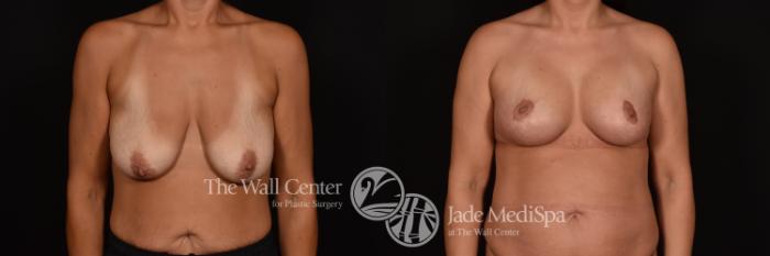 Before & After Breast Augmentation with Lift Case 1115 Front View in Shreveport, LA