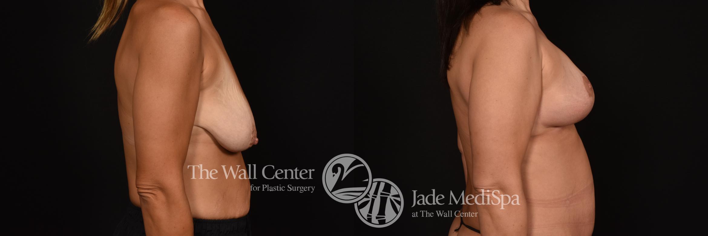 Before & After Breast Augmentation with Lift Case 1115 Right Side View in Shreveport, LA