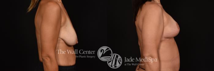 Before & After Breast Augmentation with Lift Case 1115 Right Side View in Shreveport, LA