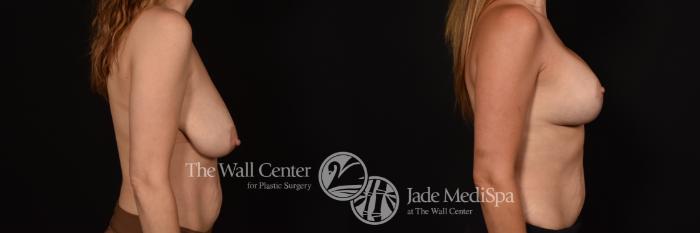 Before & After Breast Augmentation with Lift Case 1120 Right Side View in Shreveport, LA