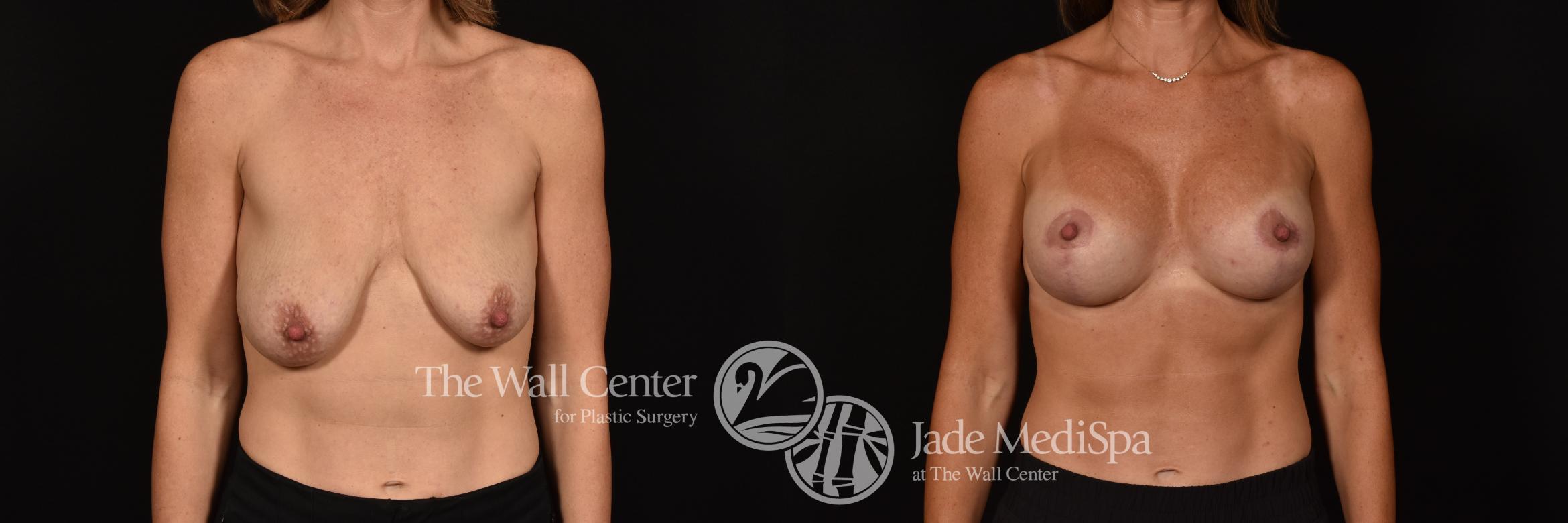 Before & After Breast Augmentation with Lift Case 1125 Front View in Shreveport, LA