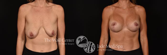 Before & After Breast Augmentation with Lift Case 1125 Front View in Shreveport, LA