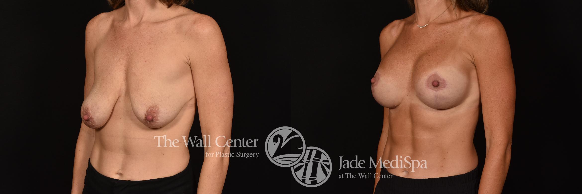 Before & After Breast Augmentation with Lift Case 1125 Left Oblique View in Shreveport, LA