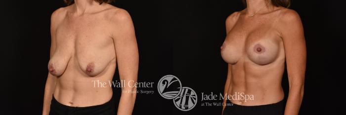 Before & After Breast Augmentation with Lift Case 1125 Left Oblique View in Shreveport, LA