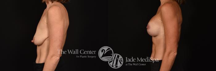 Before & After Breast Augmentation with Lift Case 1125 Left Side View in Shreveport, LA