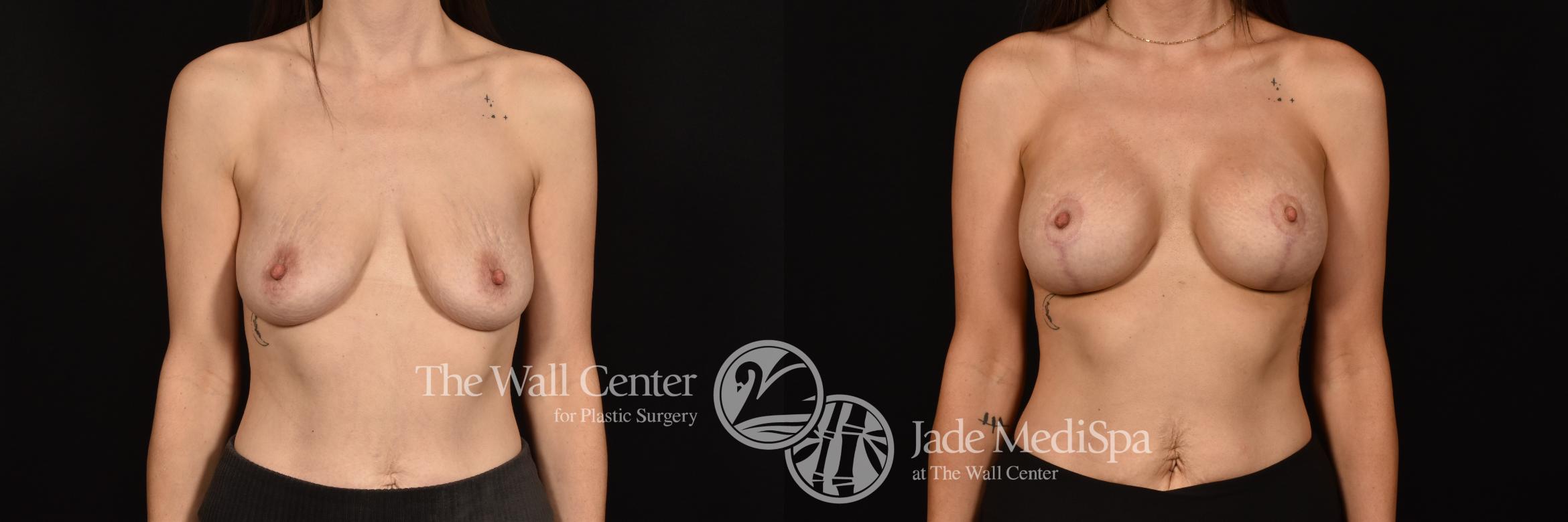 Before & After Breast Augmentation with Lift Case 1126 Front View in Shreveport, LA
