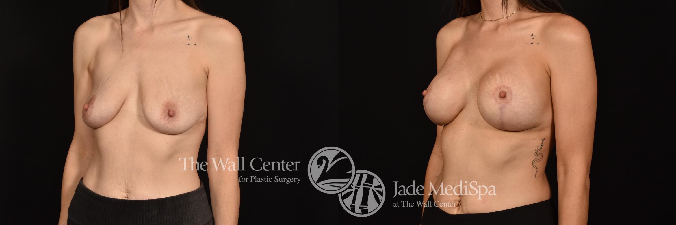 Before & After Breast Augmentation with Lift Case 1126 Left Oblique View in Shreveport, LA