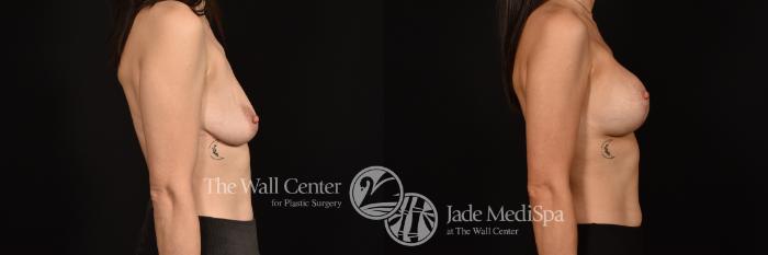 Before & After Breast Augmentation with Lift Case 1126 Right Side View in Shreveport, LA