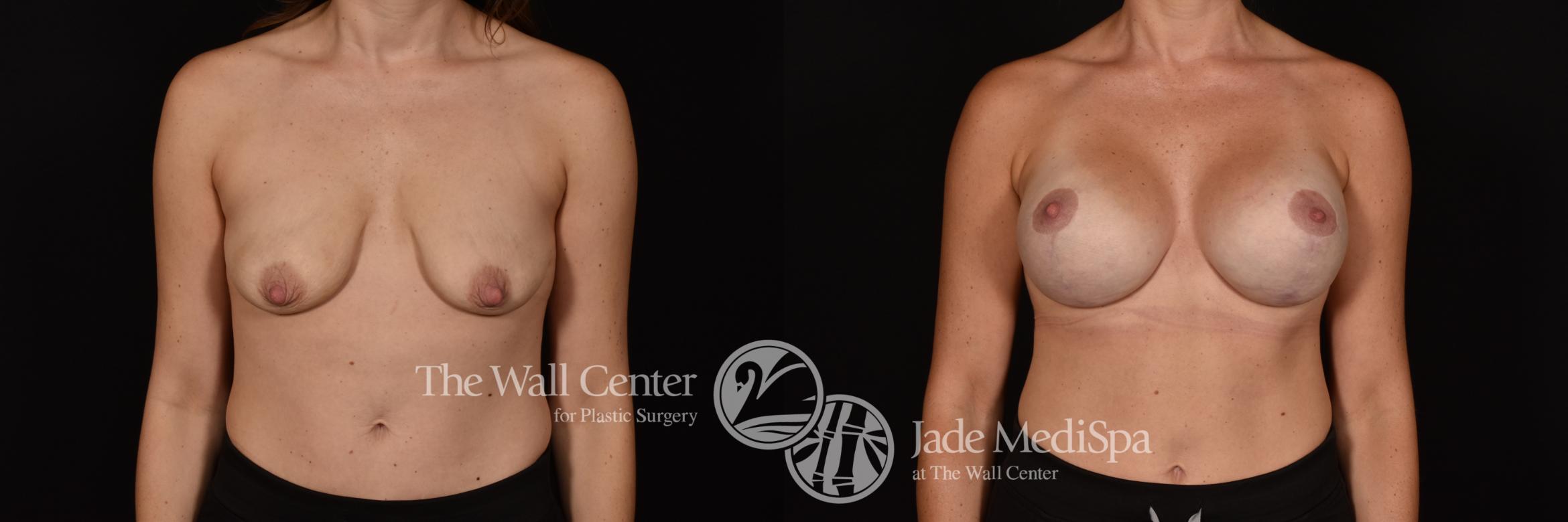 Before & After Breast Augmentation with Lift Case 1129 Front View in Shreveport, LA