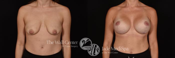 Before & After Breast Augmentation with Lift Case 1129 Front View in Shreveport, LA